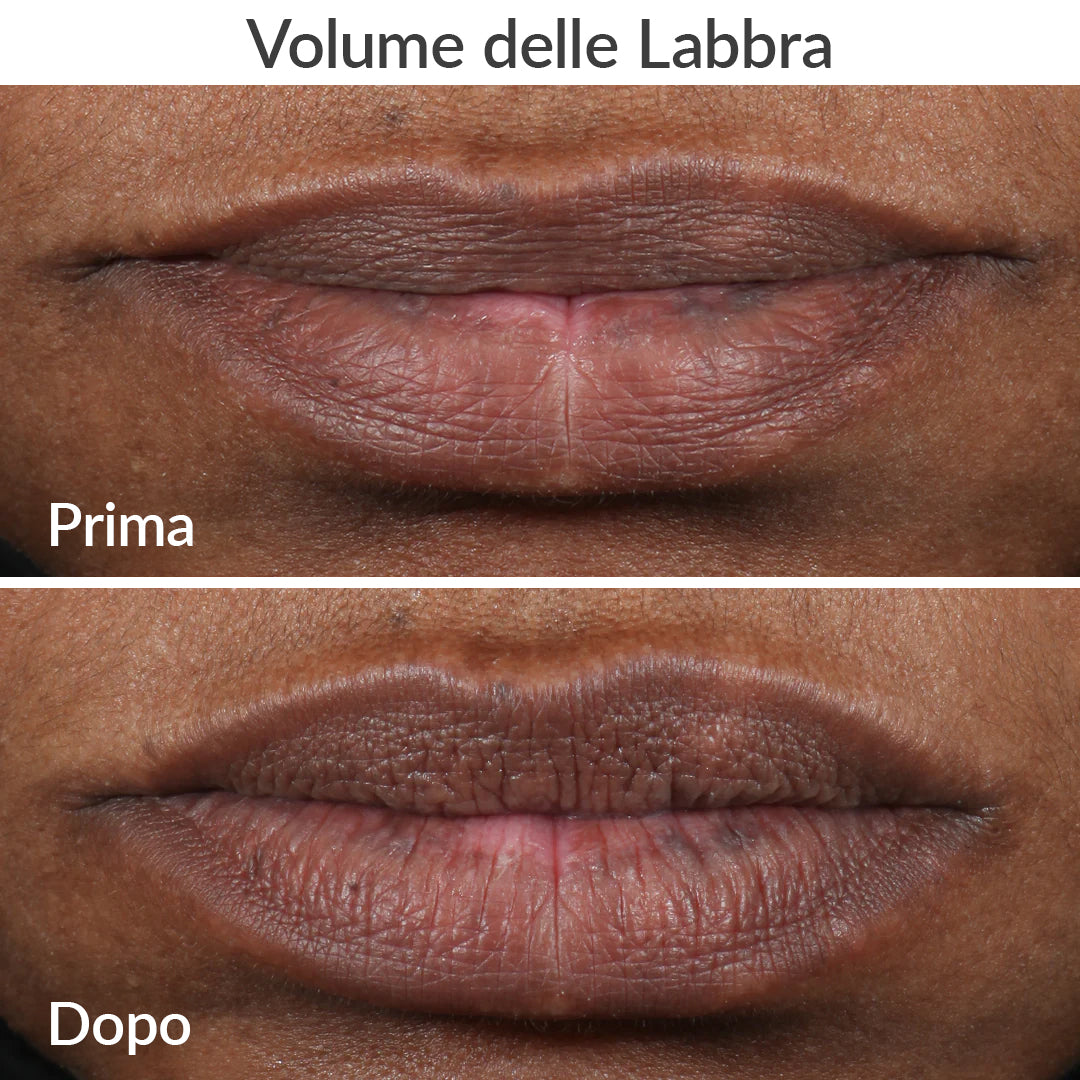 PMD Kiss System – Volume Labbra & Anti-Age con Vacuum