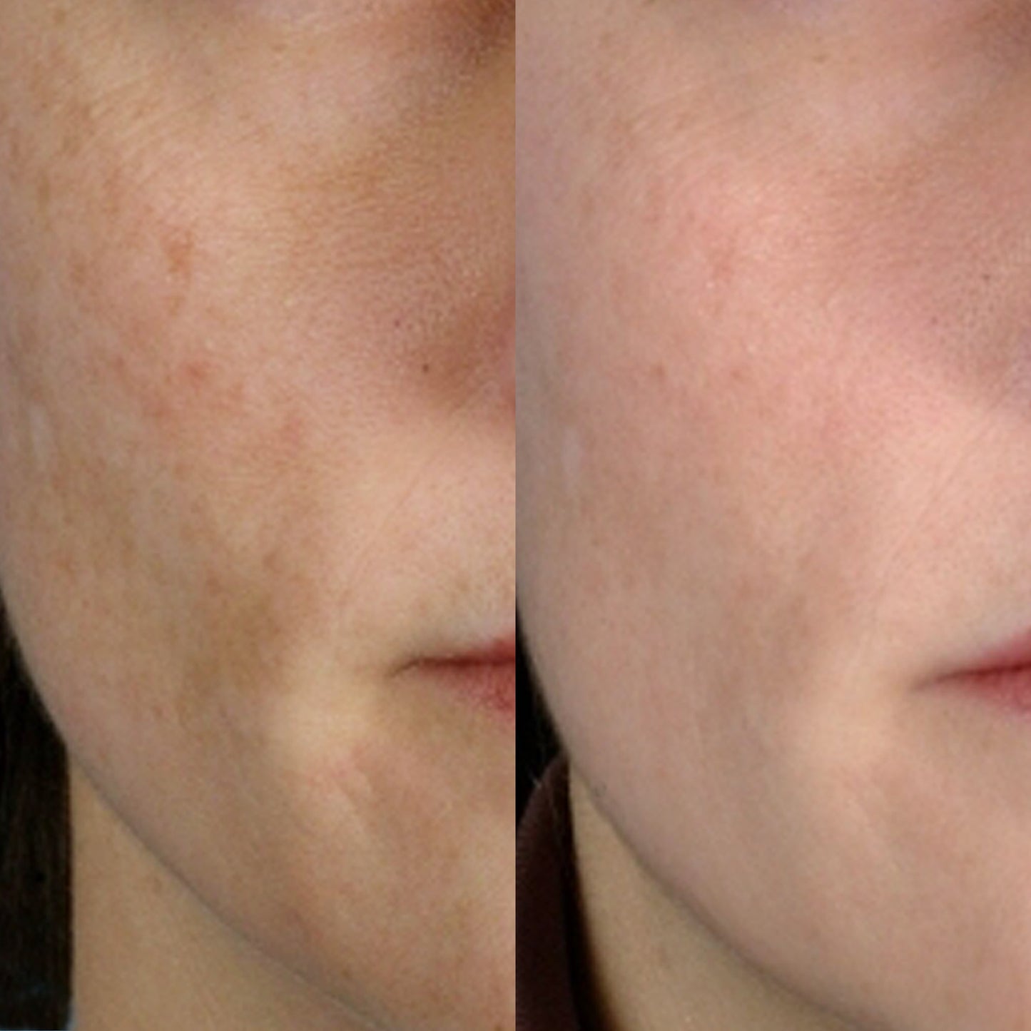 Personal Microderm Classic – Microdermoabrasione